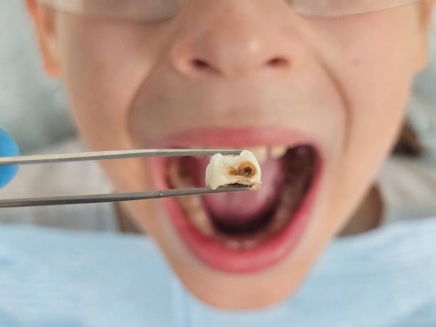 Best Dental Abscess Treatment in Willow Grove, TX